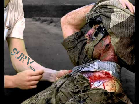 Наложение ИПП на шею